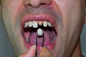 Orthodontics vs Veneers