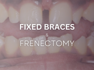 Fixed Braces and Frenectomy before and after