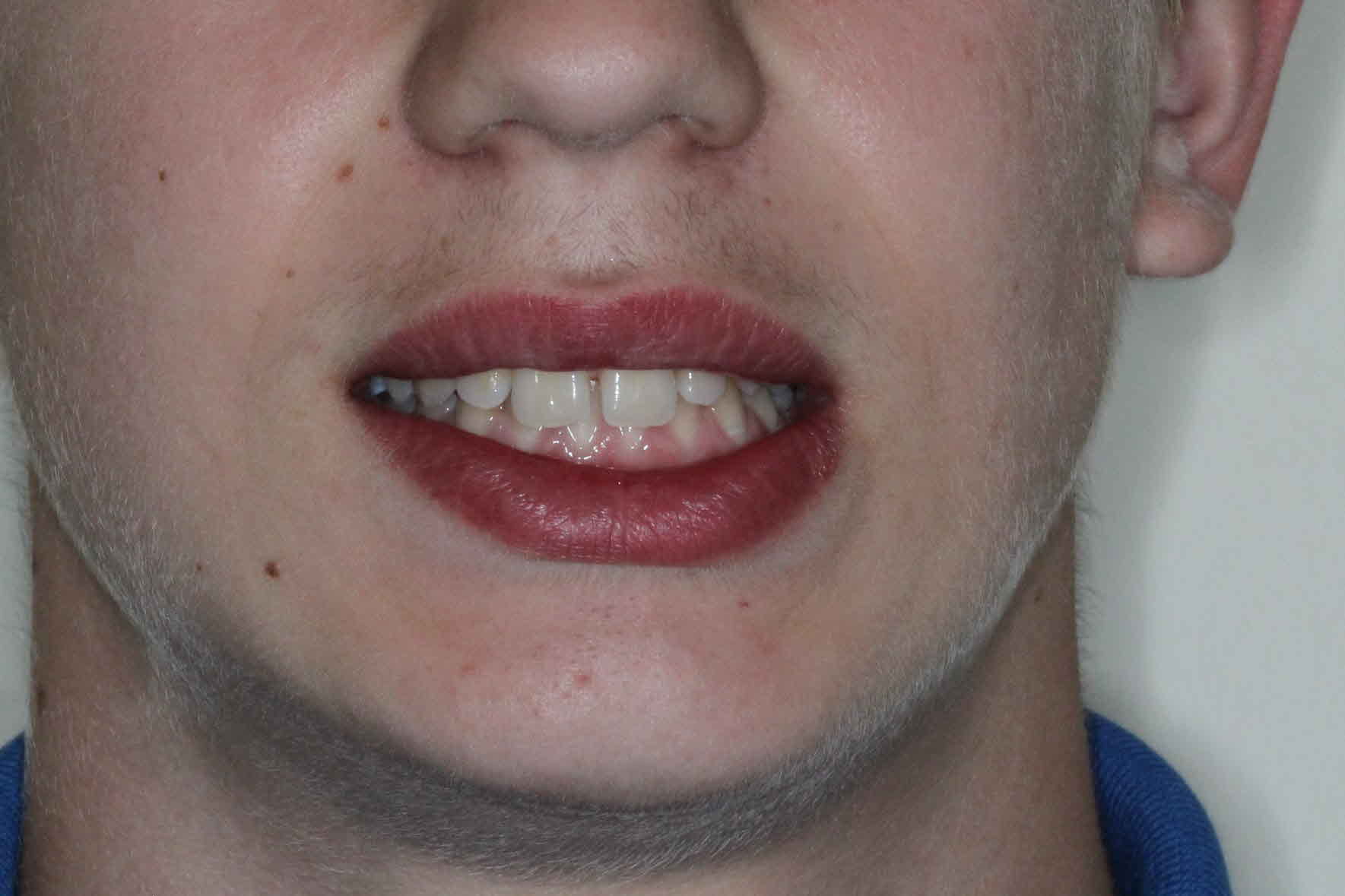 Orthodontics Results