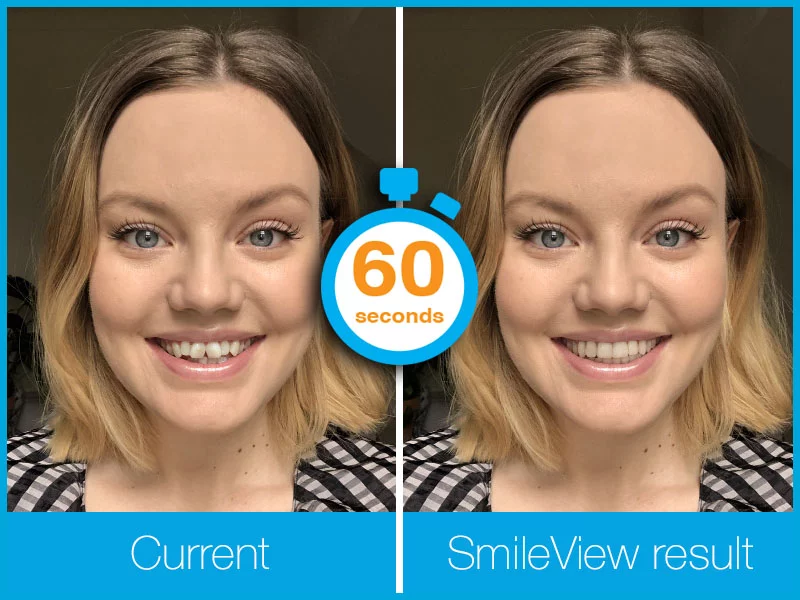 Instant Invisalign Results