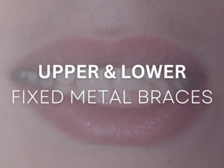 Upper and Lower Fixed Metal Braces before and after