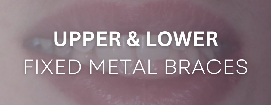 Upper and Lower Fixed Metal Braces before and after