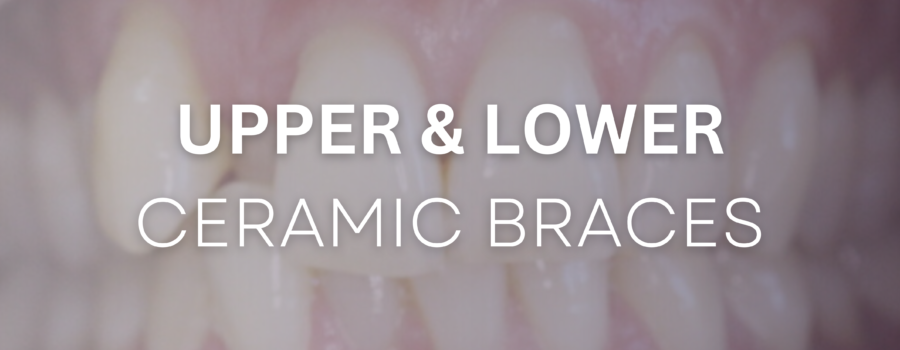 Upper and Lower Ceramic Braces before and after