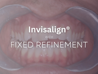 Invisalign with Fixed Refinement before and after
