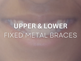 Upper and Lower Invisalign Before and after