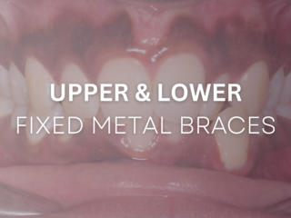 Upper and Lower Fixed Metal Braces