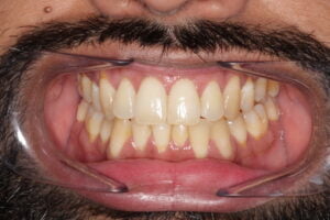 Orthodontic Relapse