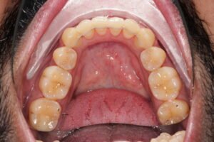 Orthodontic Relapse