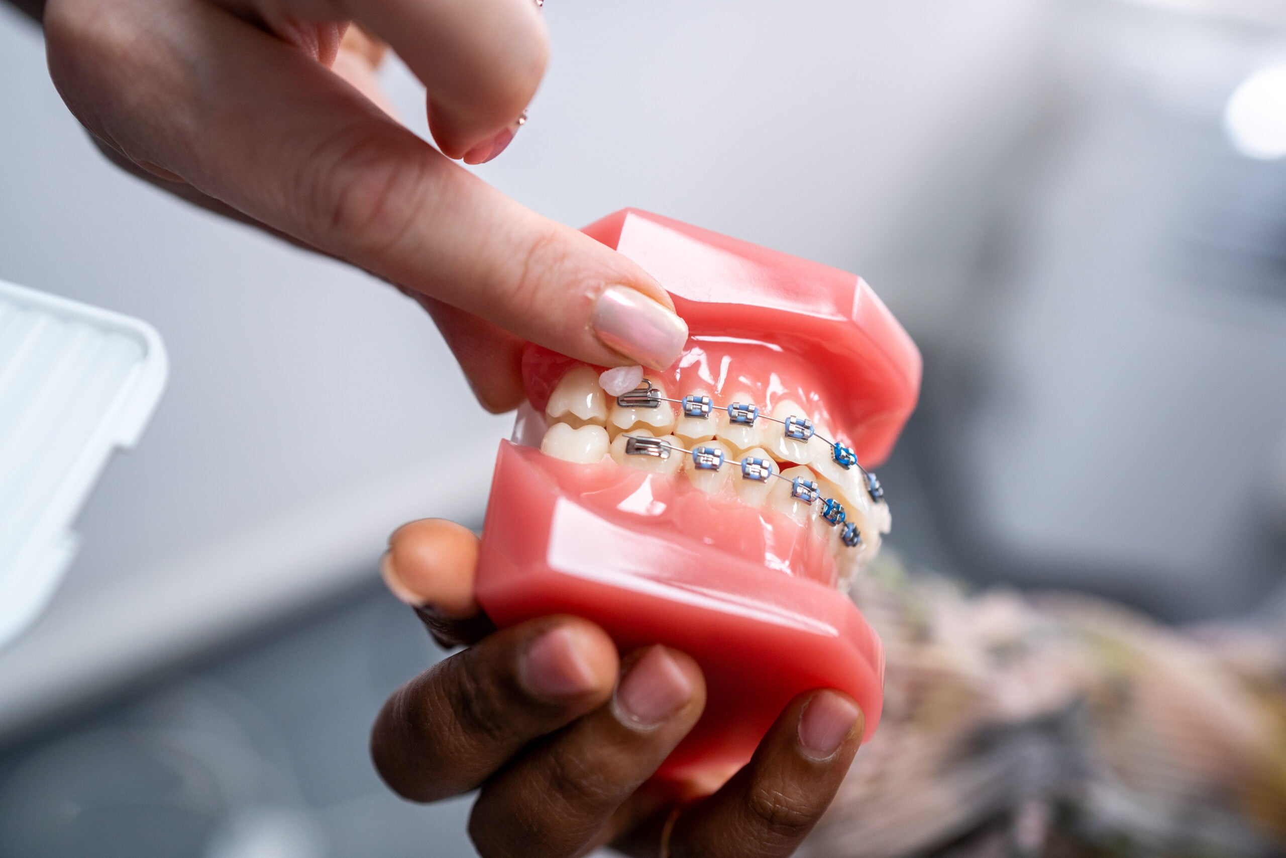 How to care for your braces