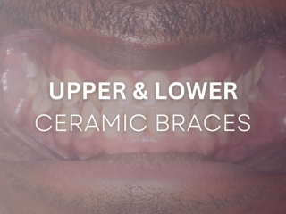 Upper and Lower Ceramic Braces