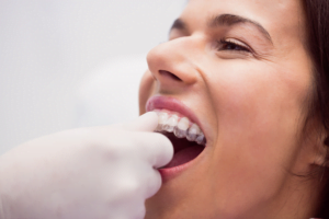 online braces versus traditional orthodontics
