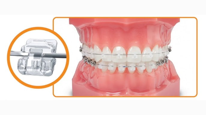 ceramic-braces