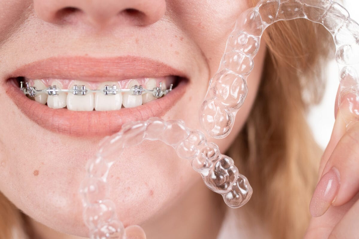 Difference between braces and clear aligners