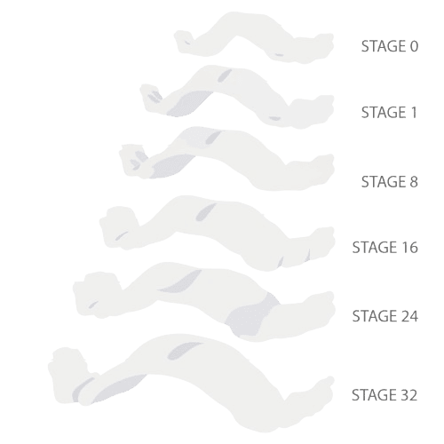 Invisalign Palate Expanders Stages