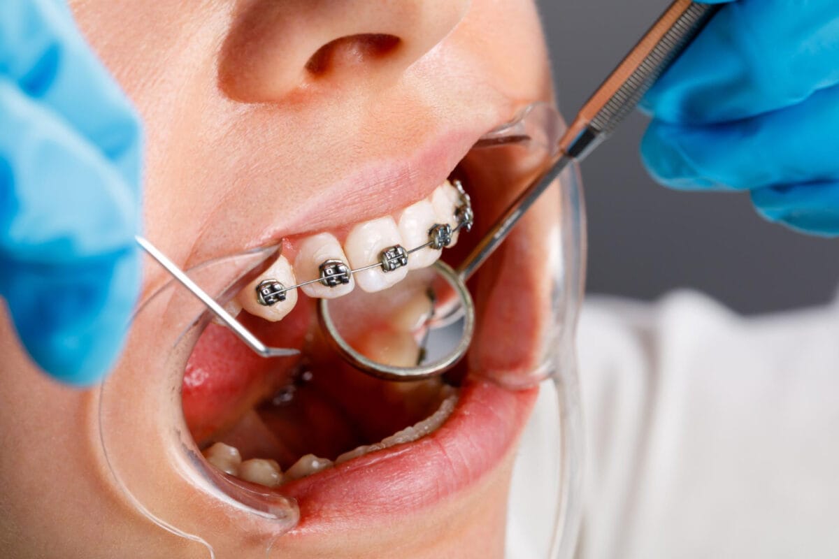 Adjusting Braces